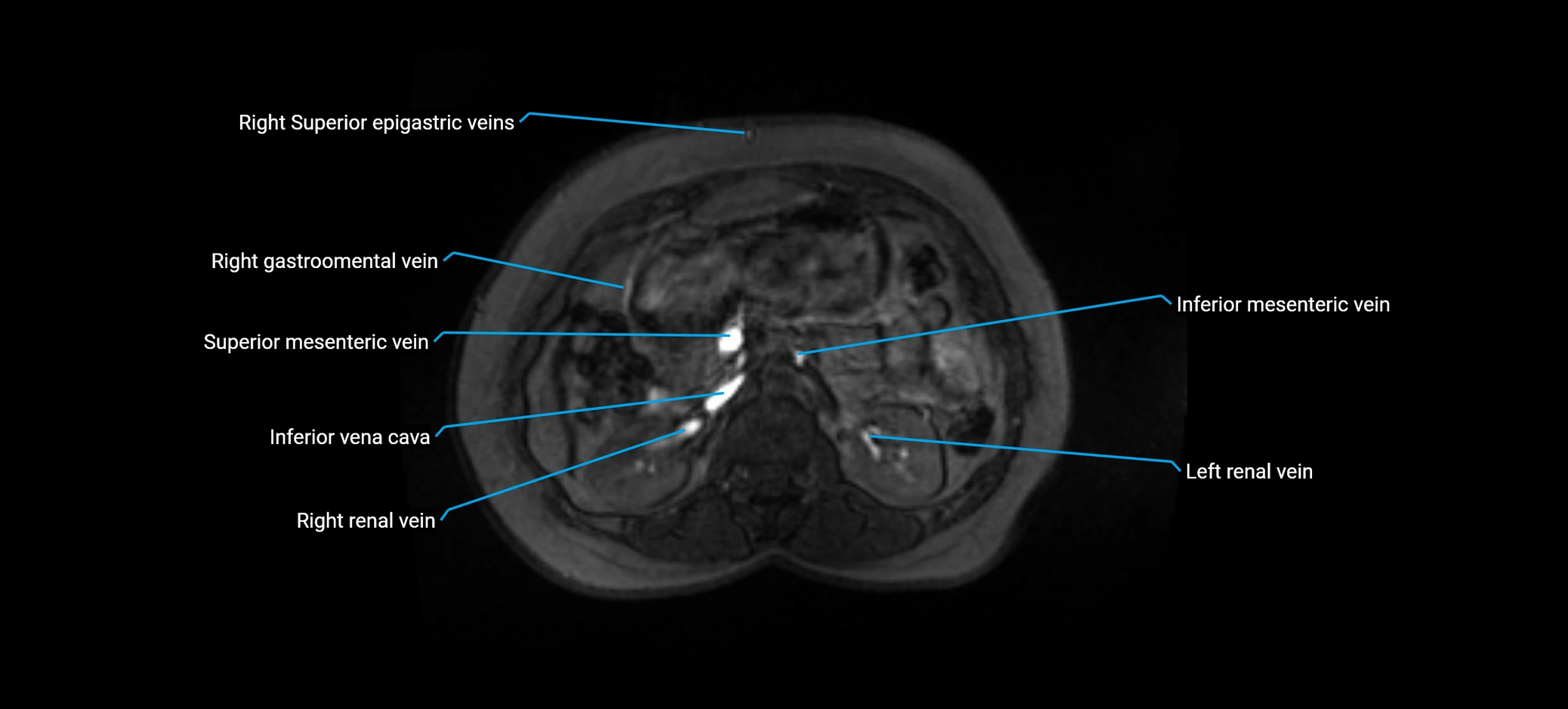 MRV abdomen pelvis & lower limb axial cross sectional anatomy labelled MRI image 66 (1).webp